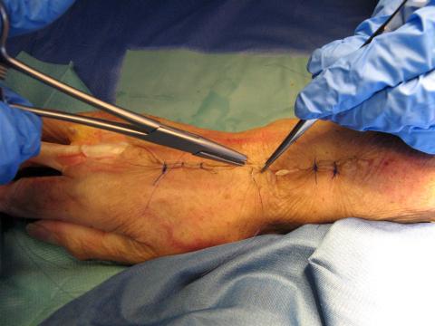 Präparation der Hand (3)