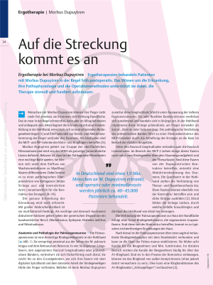 Auf die Streckung kommt es an – Ergotherapie bei Morbus Dupuytren