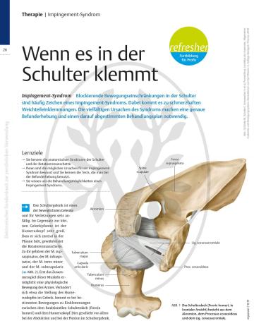 Wenn es in der Schulter klemmt – Impingement-Syndrom