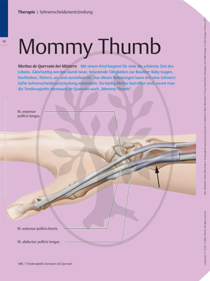 Mommy Thumb – Morbus de Quervain bei Müttern