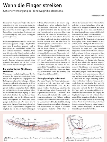 Schienenversorgung bei Tendovaginitis stenosans