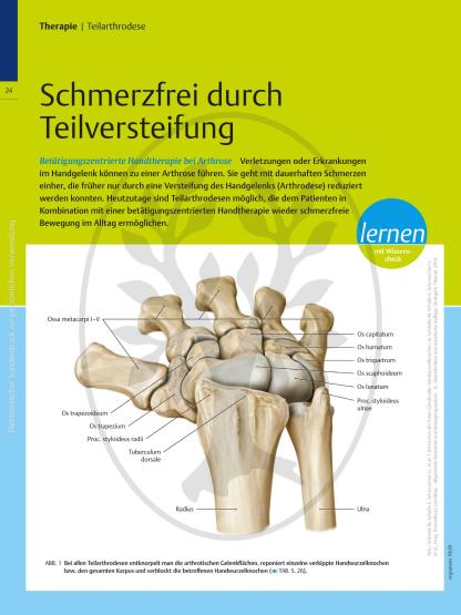 Schmerzfrei durch Teilversteifung – Betätigungszentrierte Handtherapie bei Arthrose