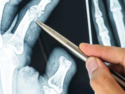 Röntgendiagnostik der Hand – grundlegende Bildgebungskenntnisse für Ergo- und Physiotherapeuten