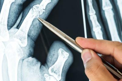 Röntgendiagnostik der Hand – grundlegende Bildgebungskenntnisse für Ergo- und Physiotherapeuten