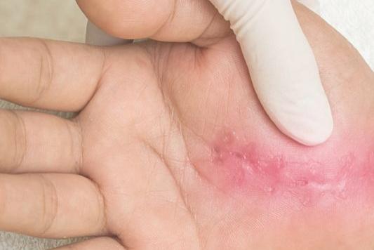 ScarWork – Narbenbehandlung und Geweberegulation für Ergo- und Physiotherapeuten