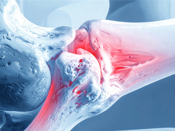 3D-gedruckte bioabbaubare Implantate unterstützen Knochenheilung