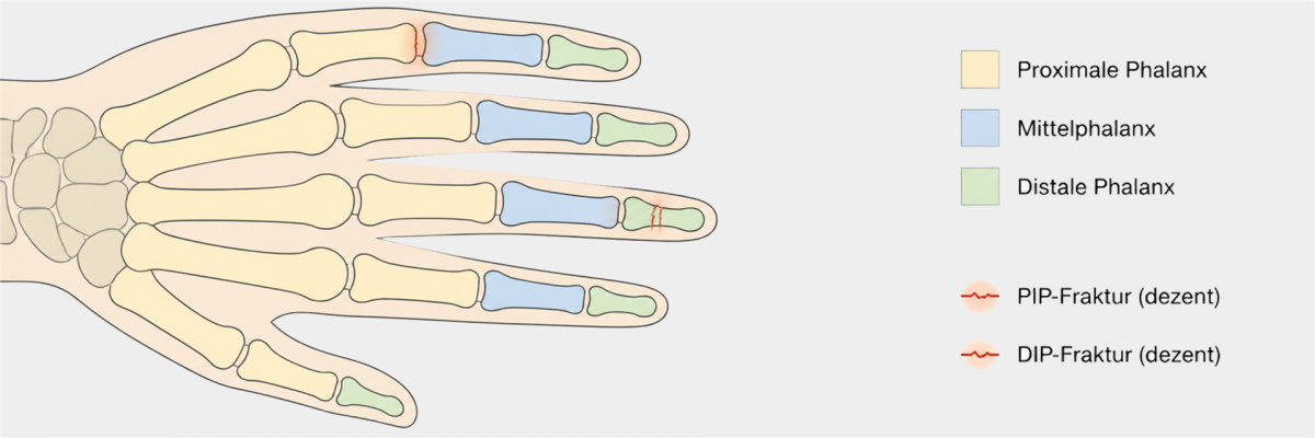 Medizinische Vektorillustration einer Hand mit schematischer Darstellung der Fingerknochen und markierten Frakturbereichen an den Phalangen.
