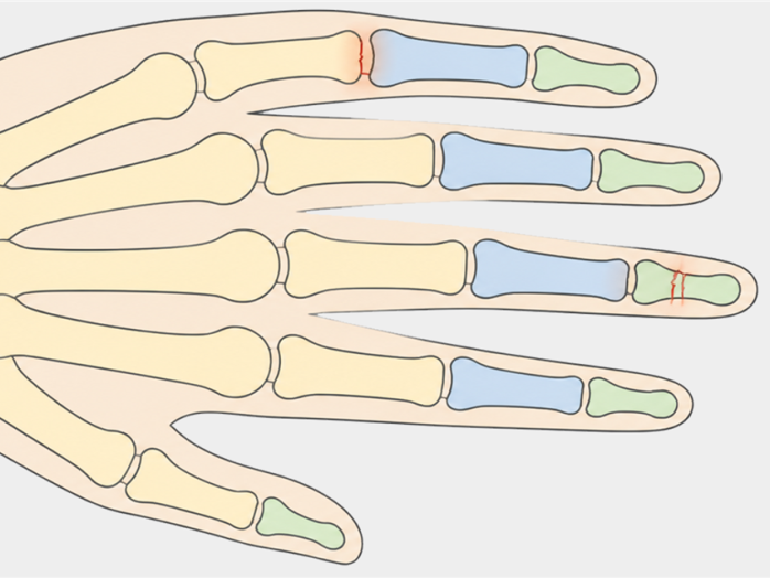 Medizinische Vektorillustration einer Hand mit schematischer Darstellung der Fingerknochen und markierten Frakturbereichen an den Phalangen.