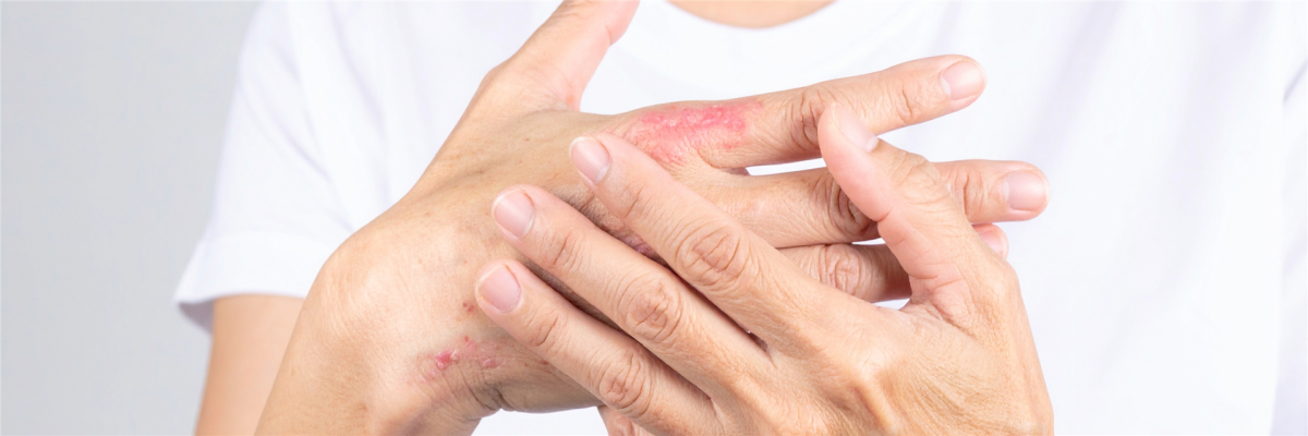 Patient mit Psoriasis-Arthritis beim Arztgespräch – Studie zeigt überwiegend leitliniengerechte Versorgung in Deutschland