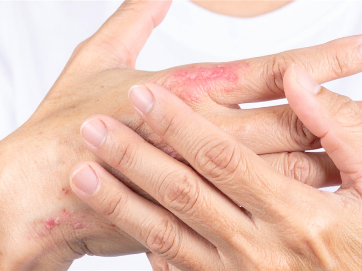 Patient mit Psoriasis-Arthritis beim Arztgespräch – Studie zeigt überwiegend leitliniengerechte Versorgung in Deutschland