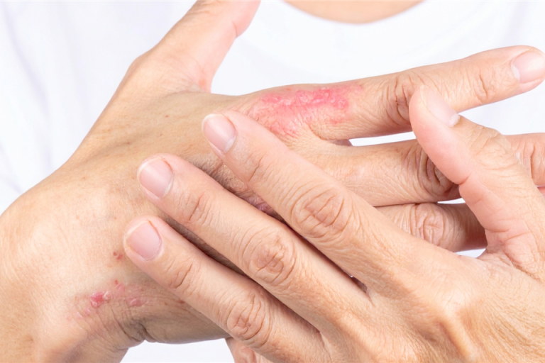 Patient mit Psoriasis-Arthritis beim Arztgespräch – Studie zeigt überwiegend leitliniengerechte Versorgung in Deutschland