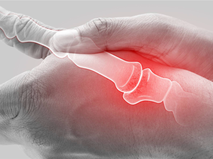 Rheumatoide Arthritis: Wenn die Gelenke betroffen sind – und das Denken mit