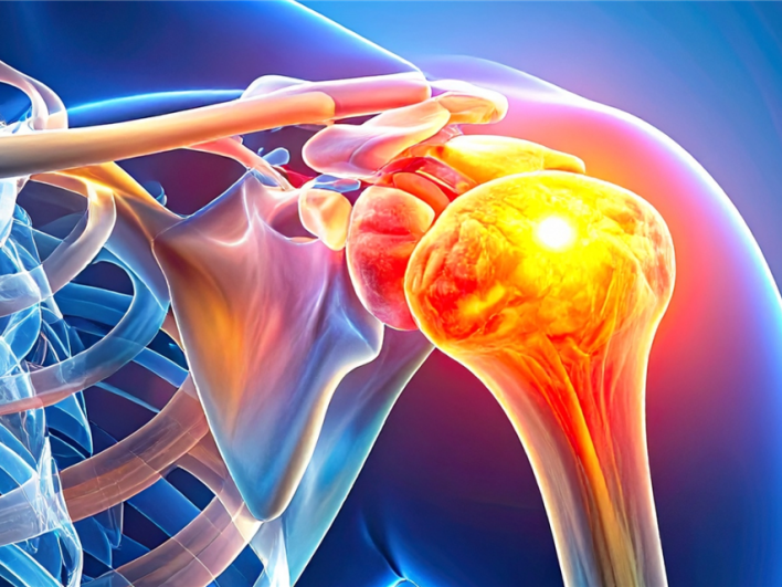 MRT-Aufnahme der Schulter mit Darstellung der Rotatorenmanschette