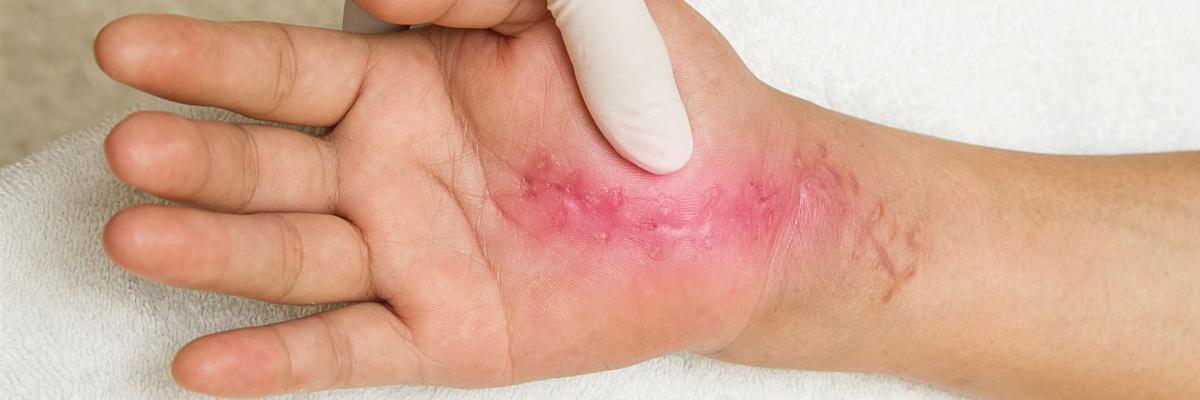 Therapeut führt ScarWork Narbenbehandlung nach Sharon Wheeler durch